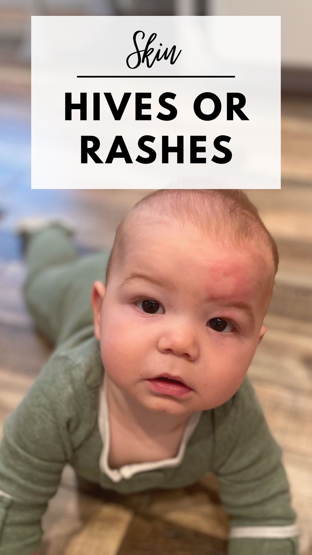 Section separator discussing hives or rashes for food allergies with baby face.