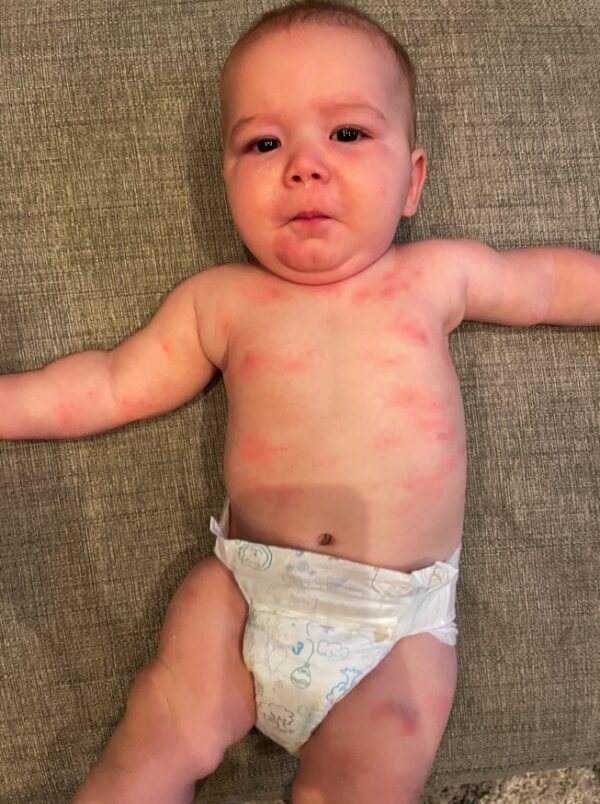 Baby Allergy Testing: What to Expect When You Test For Food Allergies