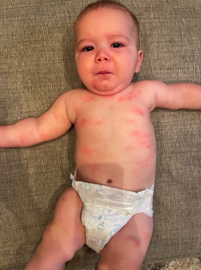 Image of baby with hives from an allergic reaction.